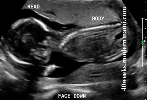Sonogram Picture from 18 weeks
